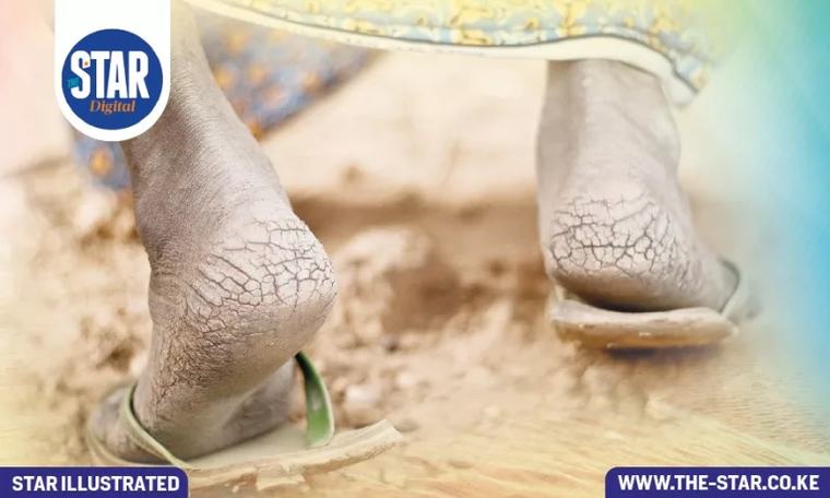 How to heal cracked heels 2d ago